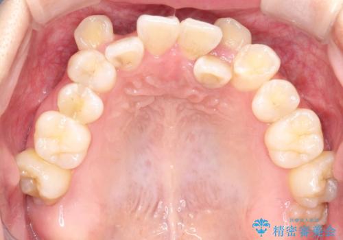 【ワイヤー矯正】八重歯 歯のでこぼこを治したい!の治療前