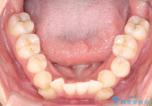 【ワイヤー矯正】八重歯 歯のでこぼこを治したい!の治療前