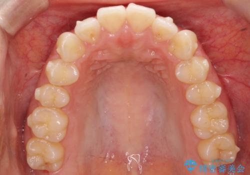 下顎前歯の叢生を短期間で改善の治療中