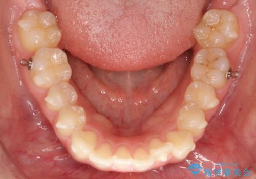 下顎前歯の叢生を短期間で改善の治療中