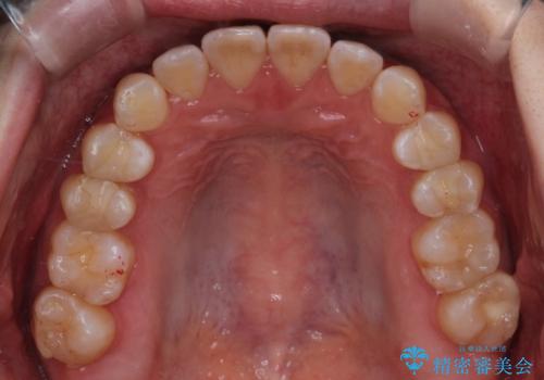 前歯と奥歯のガタガタを矯正で改善の治療中