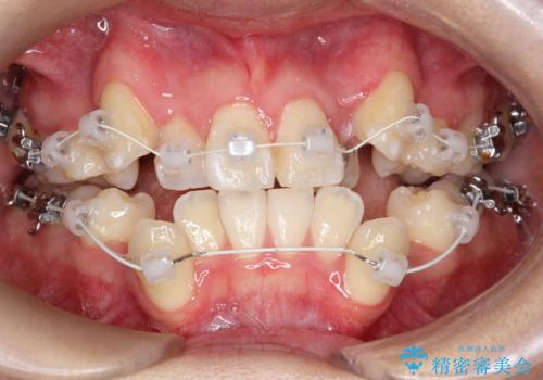 【ワイヤー矯正】八重歯　歯のでこぼこを治したい!の治療中