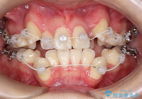 【ワイヤー矯正】八重歯 歯のでこぼこを治したい!の治療中