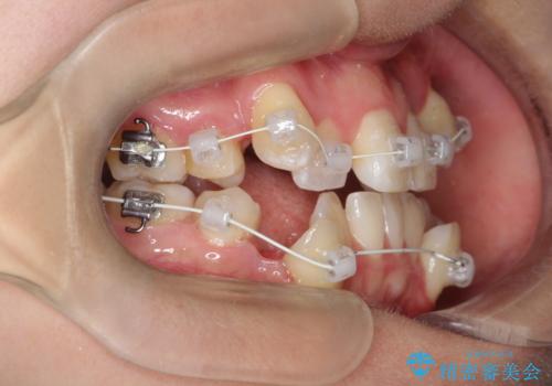 【ワイヤー矯正】八重歯 歯のでこぼこを治したい!の治療中