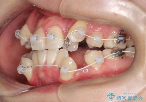 【ワイヤー矯正】八重歯 歯のでこぼこを治したい!の治療中