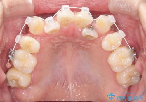 【ワイヤー矯正】八重歯　歯のでこぼこを治したい!の治療中