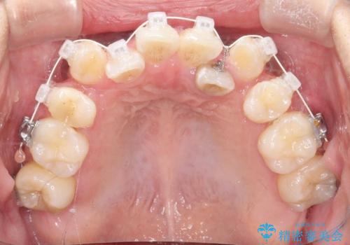 【ワイヤー矯正】八重歯 歯のでこぼこを治したい!の治療中