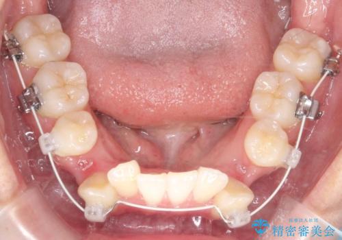 【ワイヤー矯正】八重歯 歯のでこぼこを治したい!の治療中