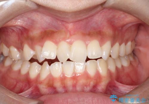 翼状捻転と叢生を矯正で改善