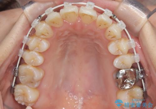 半年で改善した上顎前歯の突出の治療中