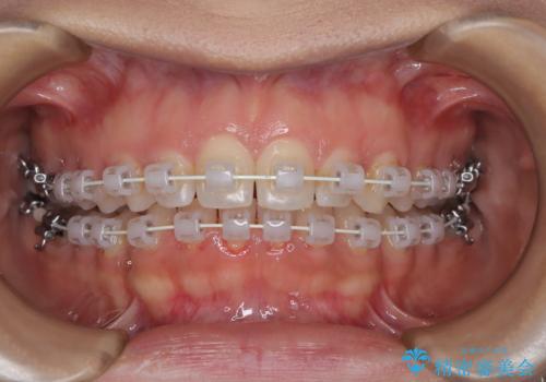 上顎前突を非抜歯で改善の治療中