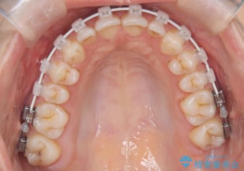 上顎前突を非抜歯で改善の治療中