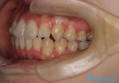 インビザラインで上下の叢生を改善の治療中