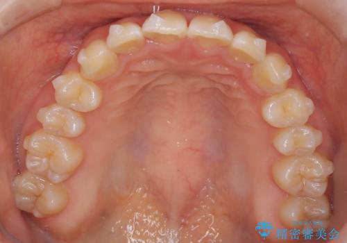 インビザラインで上下の叢生を改善の治療中