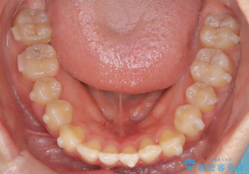 インビザラインで上下の叢生を改善の治療中