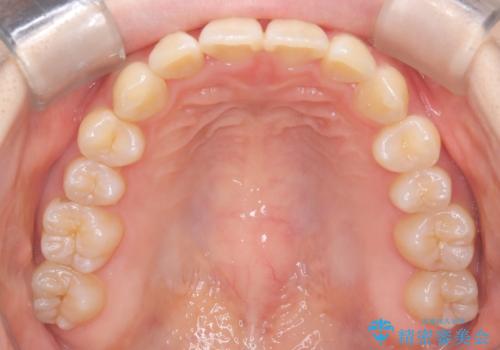 インビザラインで上下の叢生を改善の治療後