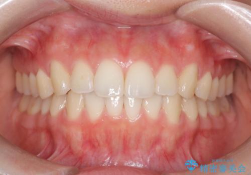 下顎前歯の叢生を短期間で改善の症例 治療後