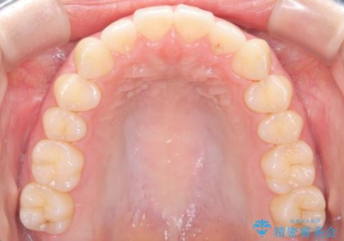 下顎前歯の叢生を短期間で改善の治療後