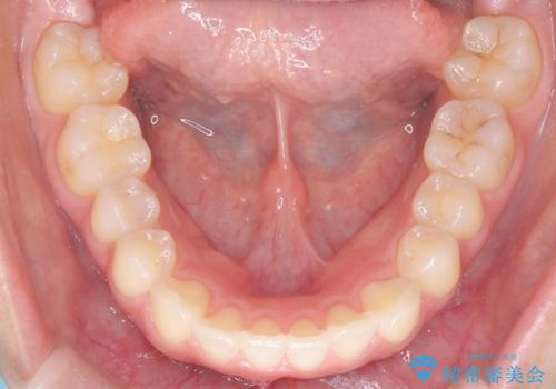 下顎前歯の叢生を短期間で改善の治療後