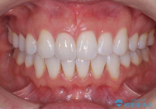 前歯の色・形が気になる オールセラミッククラウンで綺麗に (アライナー矯正併用)の治療後