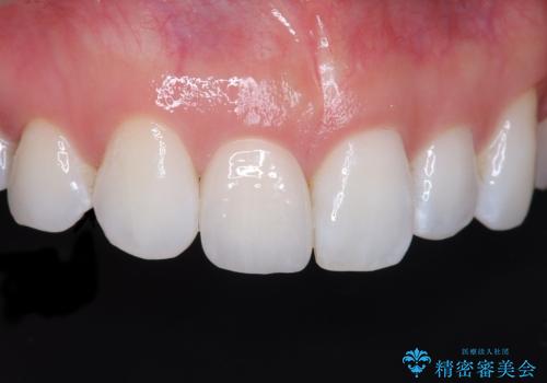 前歯の色・形が気になる オールセラミッククラウンで綺麗に (アライナー矯正併用)の症例 治療後