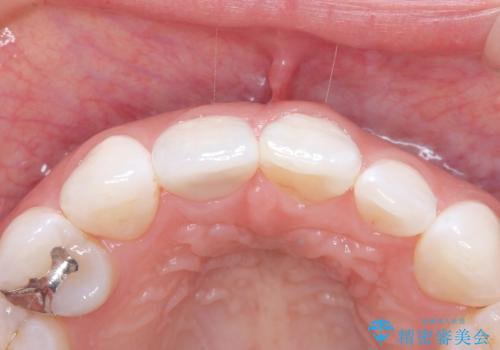 前歯の色・形が気になる オールセラミッククラウンで綺麗に (アライナー矯正併用)の治療後