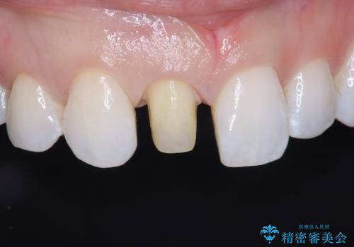 前歯の色・形が気になる オールセラミッククラウンで綺麗に (アライナー矯正併用)の治療中