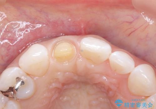 前歯の色・形が気になる オールセラミッククラウンで綺麗に (アライナー矯正併用)の治療中
