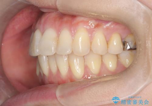 半年で改善した上顎前歯の突出の治療後