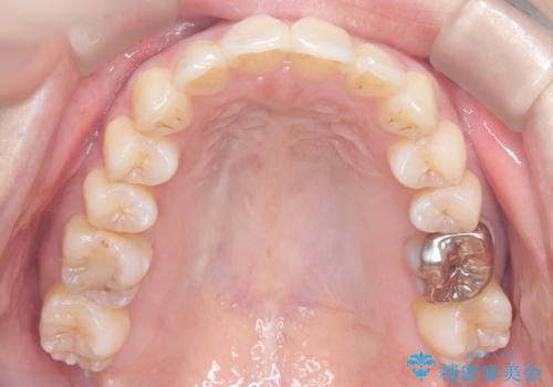 半年で改善した上顎前歯の突出の治療後