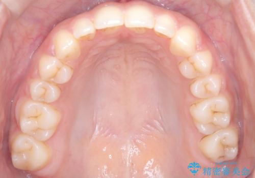 上顎前突を非抜歯で改善の治療後