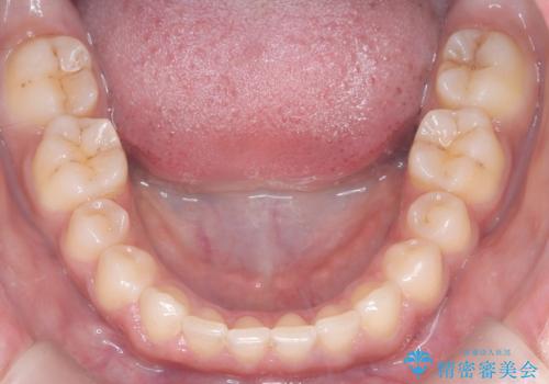 上顎前突を非抜歯で改善の治療後