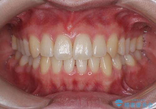 前歯のガタガタと欠損部を改善の症例 治療後