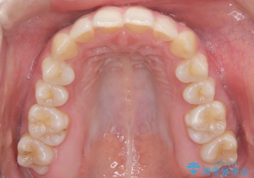前歯のガタガタと欠損部を改善の治療後