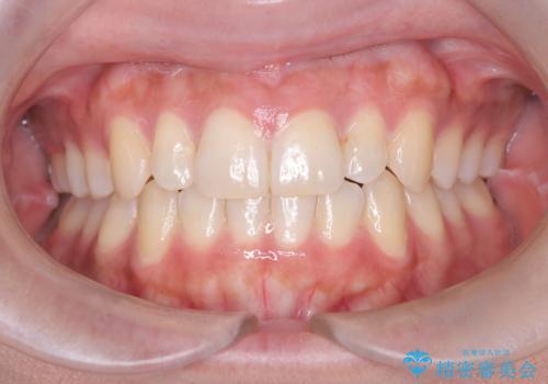 反対咬合と前歯のガタガタを非抜歯で改善の症例 治療後