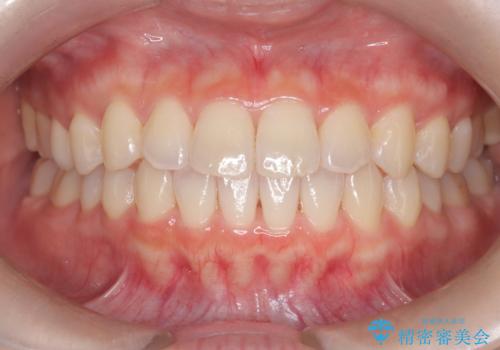 前歯と奥歯のガタガタを矯正で改善の症例 治療後