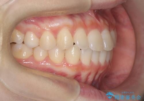 前歯と奥歯のガタガタを矯正で改善の治療後