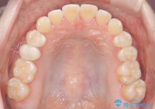 前歯と奥歯のガタガタを矯正で改善の治療後