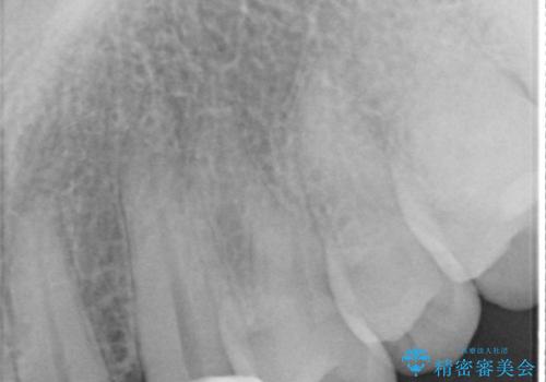 転んで欠けた前歯を治したい。オールセラミッククラウンによる補綴の治療後