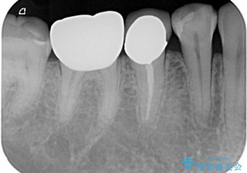 検診で見つかった齲蝕のセラミックインレー修復の治療後