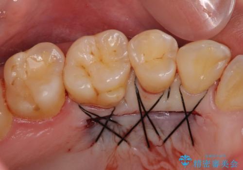 半分以上歯根が見えている　歯肉移植による根面被覆術の治療中