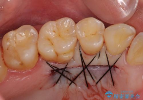 半分以上歯根が見えている 歯肉移植による根面被覆術の治療中