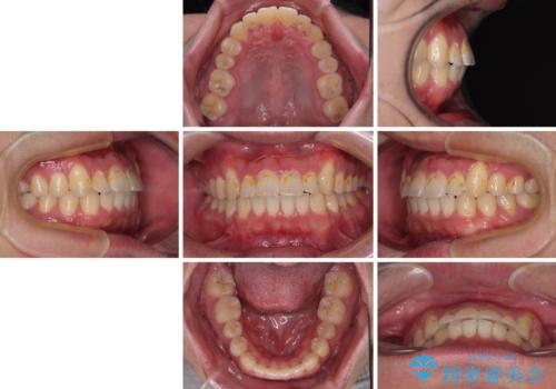 目立つ八重歯を非抜歯矯正で整える 目立たないワイヤー矯正の治療後