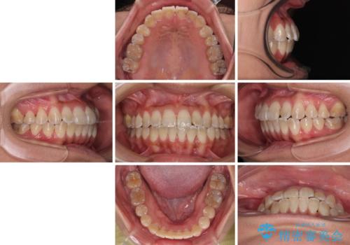 全く目立たないワイヤー矯正 上下裏側矯正の治療後