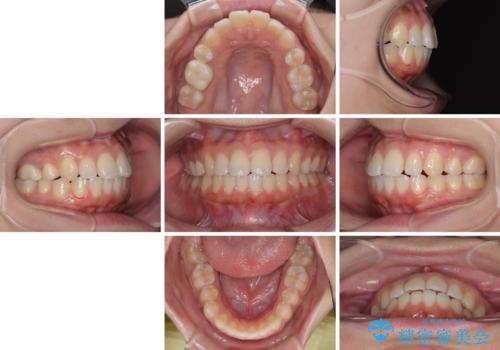 再矯正 開咬に後戻りした歯列をインビザラインで改善の治療後