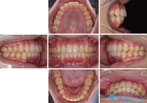 前歯のデコボコを治したい　ワイヤー装置での非抜歯矯正の治療後