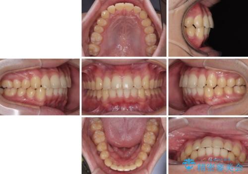 前歯のデコボコを治したい ワイヤー装置での非抜歯矯正の治療後