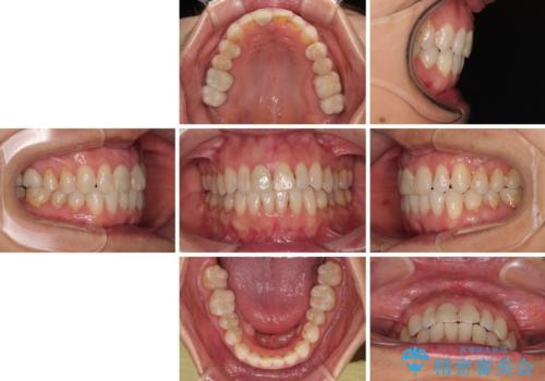 デコボコと銀歯 矯正治療とセラミック治療で綺麗な口元にの治療後