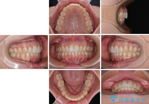 前に飛び出して目立っている前歯を整える　インビザライン矯正治療の治療後