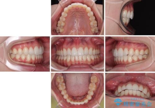【モニター】前に傾斜した前歯　インビザラインでスッキリとした口元にの治療後